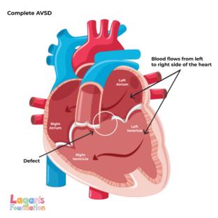 A Guide to Atrioventricular Septal Defects (AVSD)